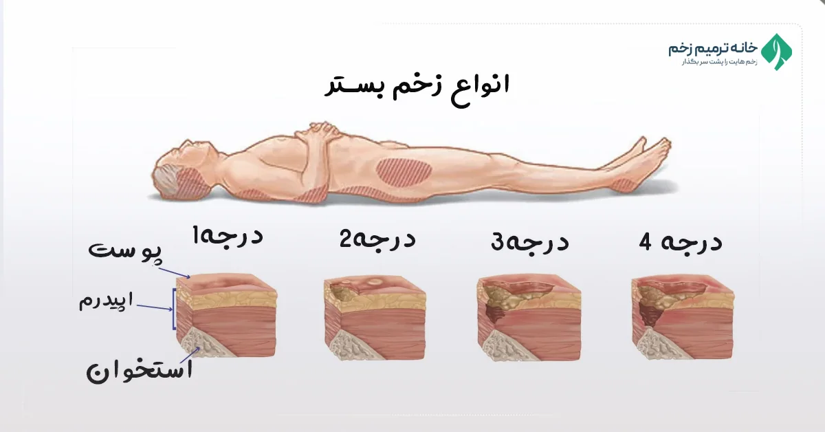 زخم بستر چیست و چرا درمان زخم بستر اهمیت حیاتی دارد؟